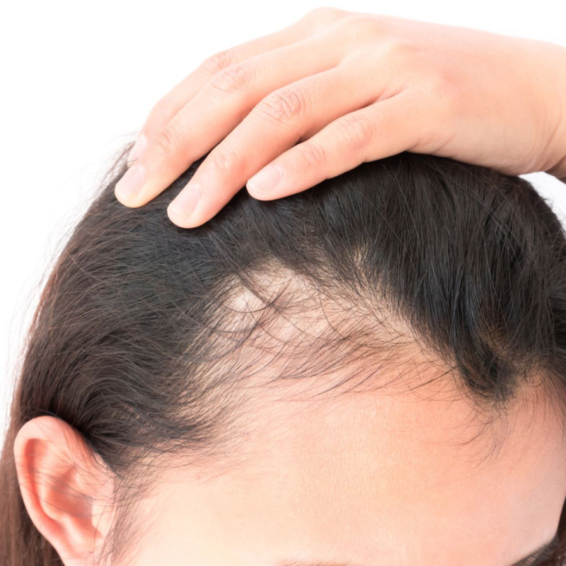 Hairfall and Thinning