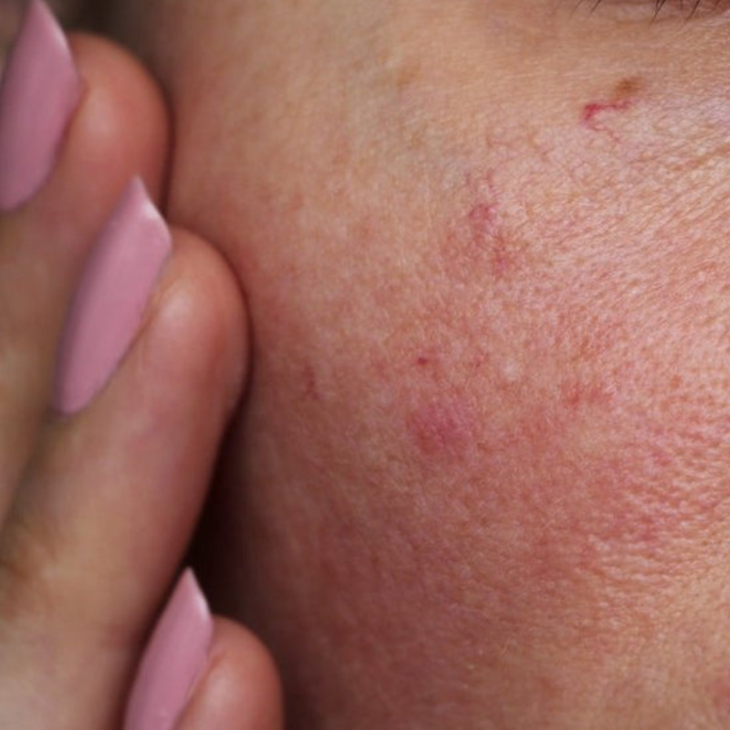 Sensitive and Barrier Repair